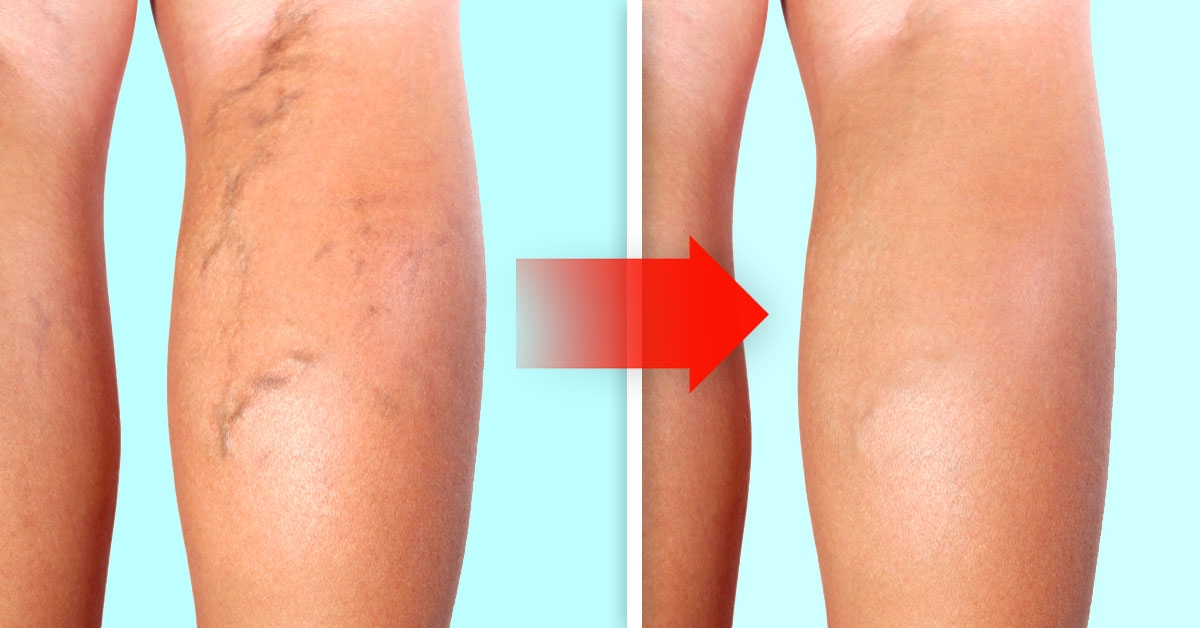 mejores ejercicios eliminar varices mejores ejercicios eliminar varices