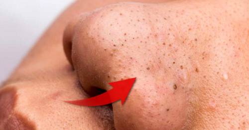 4 métodos sencillos para tratar las espinillas de la cara