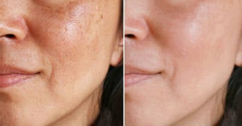 Cómo hacer una limpieza con cúrcuma y jengibre para eliminar manchas de tu rostro Cómo hacer una limpieza con cúrcuma y jengibre para eliminar manchas de tu rostro