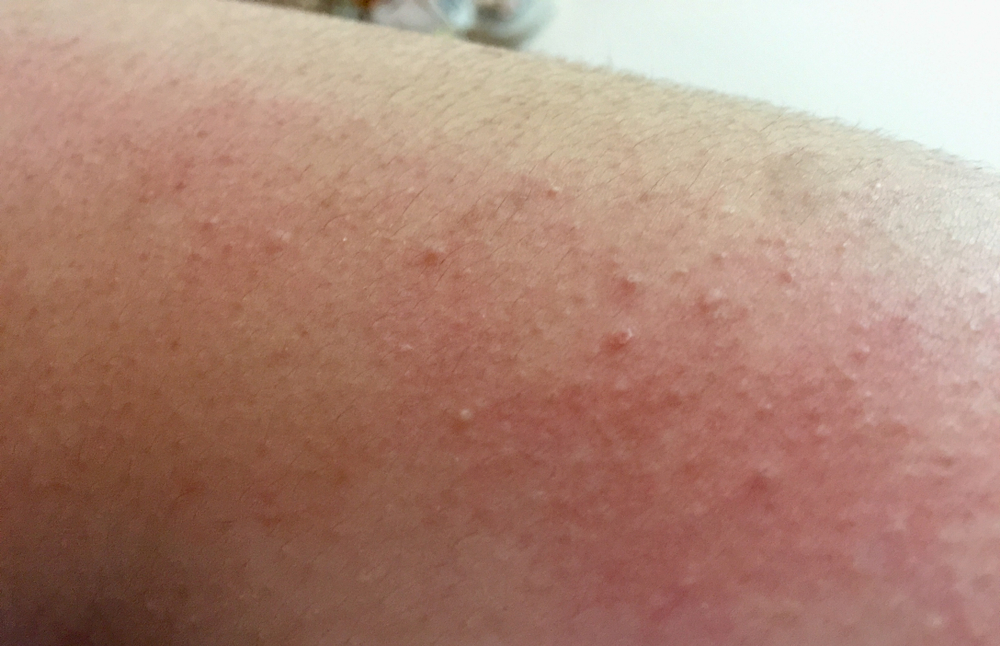 granitos en los brazos enfermedad granitos en los brazos