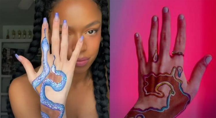 vitiligo2 vitiligo2