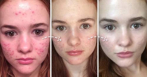 13 Sorprendentes Razones Por Las Cuales Tienes Acne Y Como Eliminarlo Bioguia