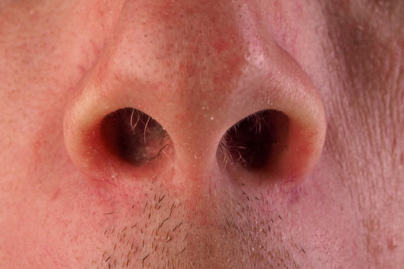 papiloma fosa nasal