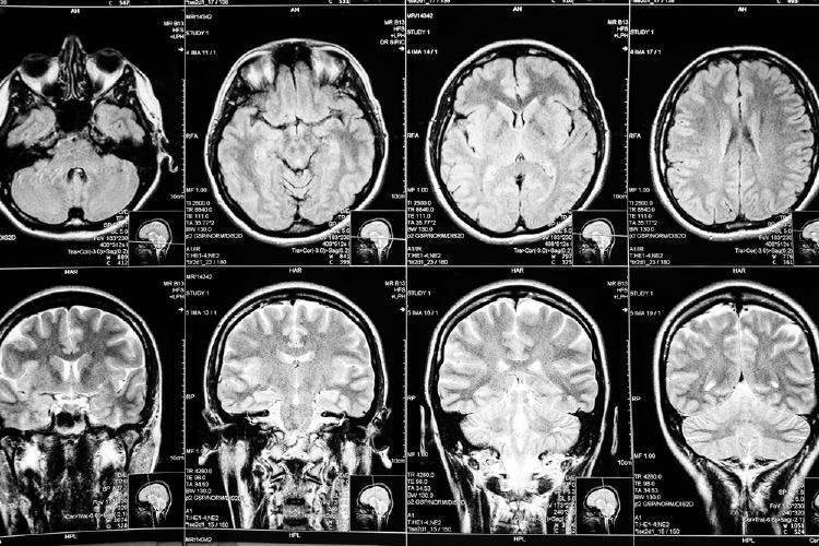 cerebro cerebro