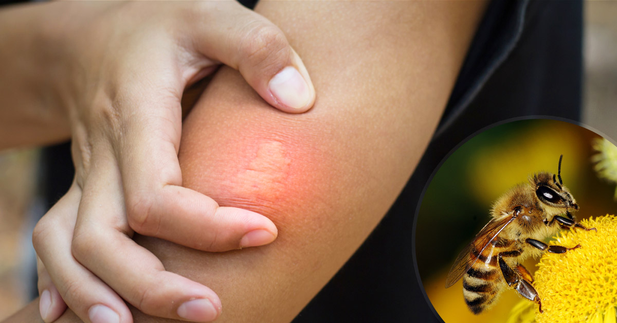 calmar-ardor-picaduras-abejas calmar-ardor-picaduras-abejas