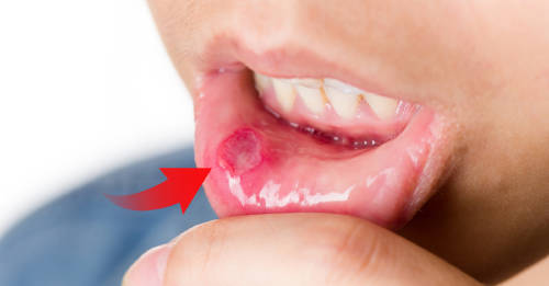 A qué se deben las llagas en los labios