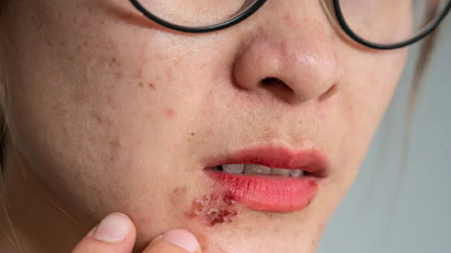 virus Epstein Barr: el \"virus del beso\" que genera enfermedades es frecuente en la población mundial. (Foto: telecinco.es)