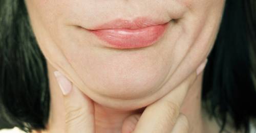 puntos negros menton barbilla puntos negros menton barbilla