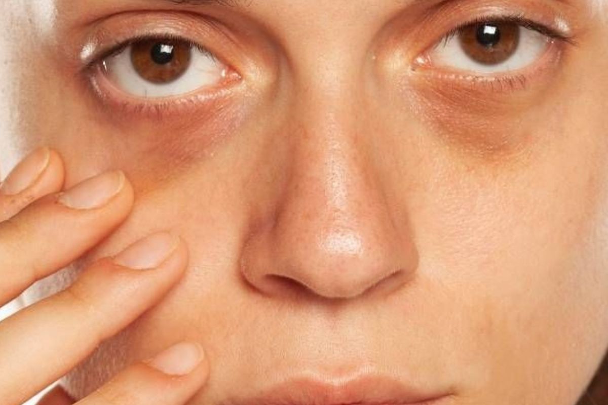 ojeras Las ojeras son una alteración del color en la piel del párpado inferior. (PINTEREST)