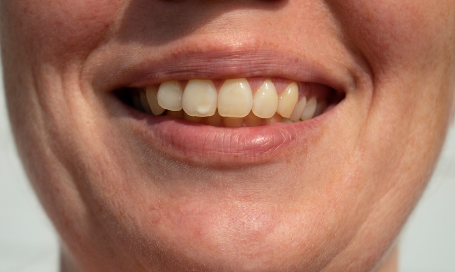 dientes manchas blancas