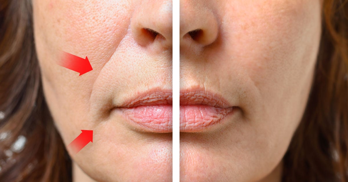 Como eliminar completamente las arrugas alrededor de la boca | Bioguia