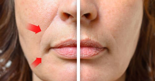 eliminar completamente arrugas boca eliminar completamente arrugas boca