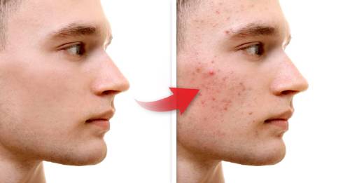 9 factores pueden causa acne