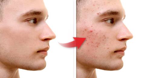 9 factores pueden causa acne 9 factores pueden causa acne