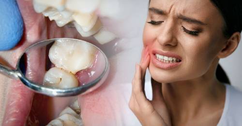 estas pueden ser las causas caries en adultos estas pueden ser las causas caries en adultos