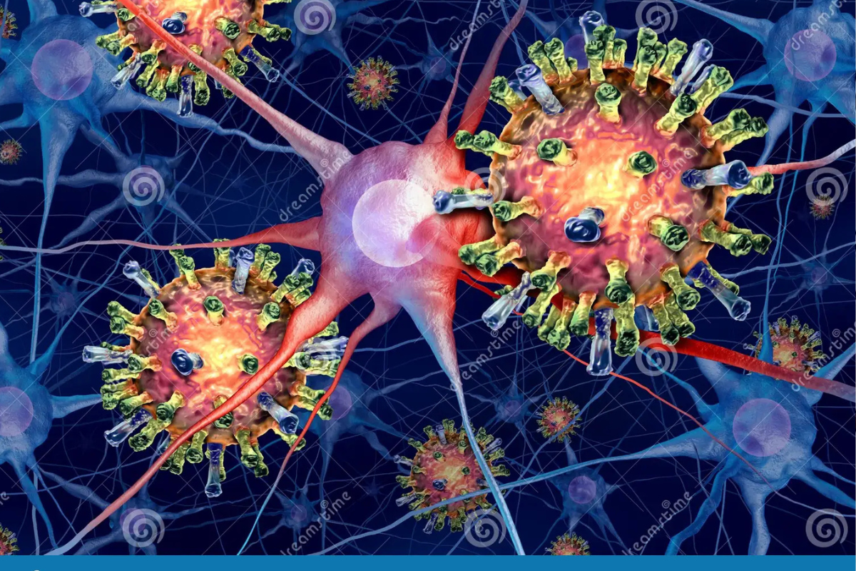 sarampion Infección de la encefalitis como virus de sarampión en el cerebro que infecta las neuronas microscópicas como concepto viral de la meningitis como representación 3D. (Foto: es.dreamstime.com)