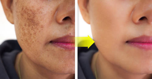 mascarilla limon perejil manchas cara mascarilla limon perejil manchas cara