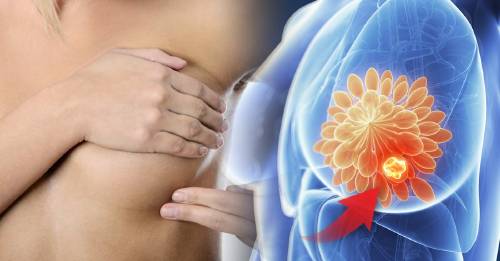 Estas son las señales tempranas de cáncer de mama que deberías conocer