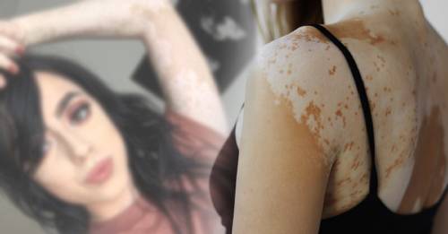 La chica popular de Instagram que muestra su condición corporal y la vuelve arte