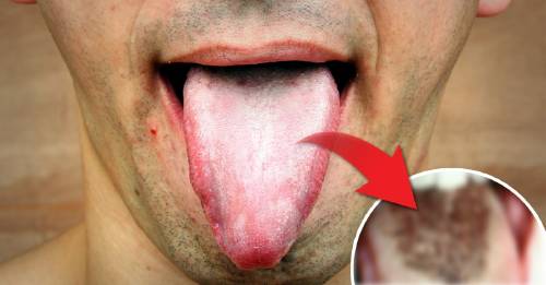 ¿Qué es la extraña enfermedad de la lengua peluda? Así es y estas son las causas