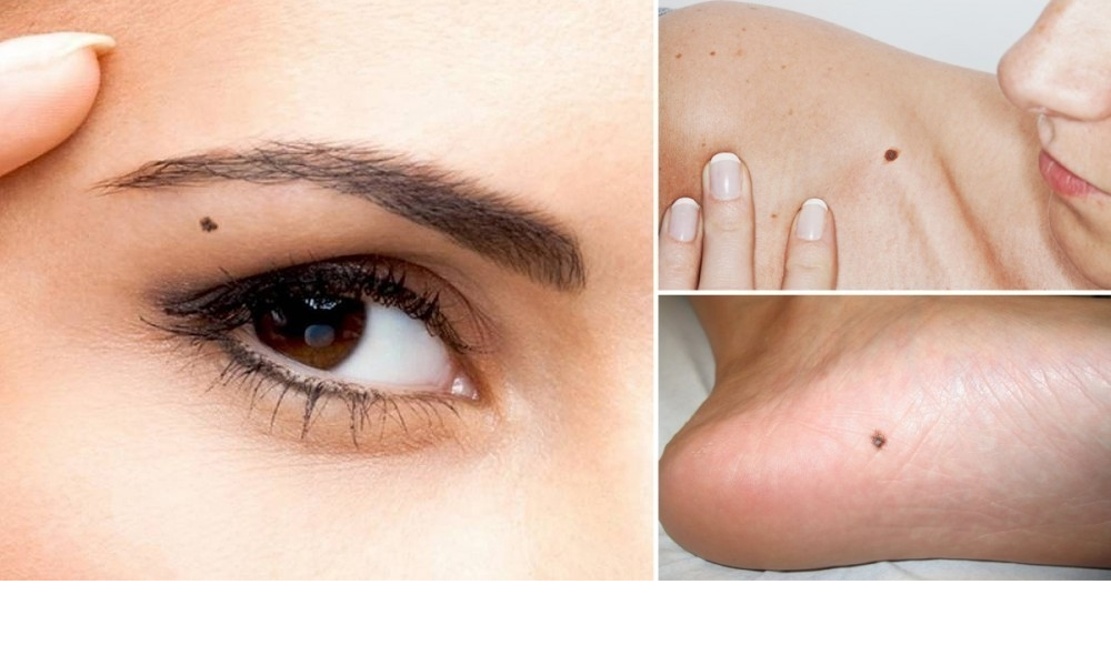 Lunares 2 Lunares malignos