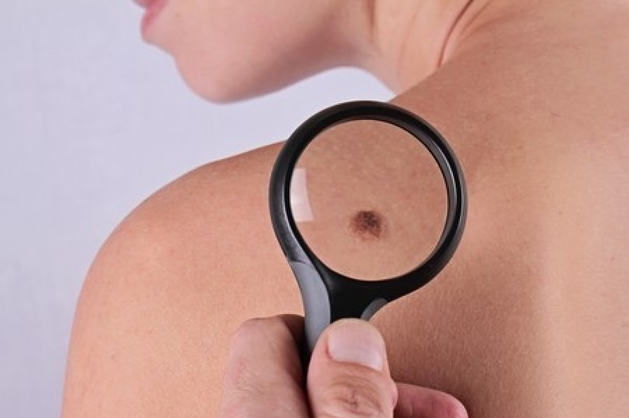 lunar lupa Lunares malignos